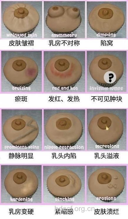 乳腺癌患者的乳头有哪些变化