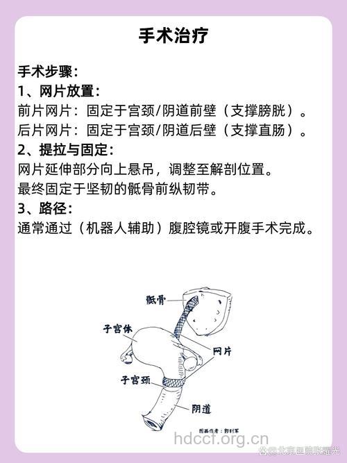 有哪些防治子宫脱垂方法