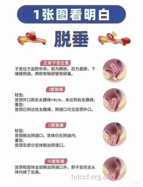 子宫脱垂有哪些不良反应