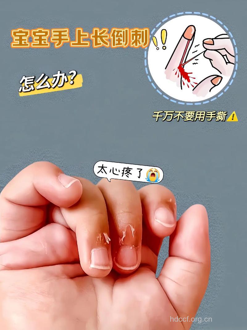 秋季手上长倒刺难受极了 教你预防的方法