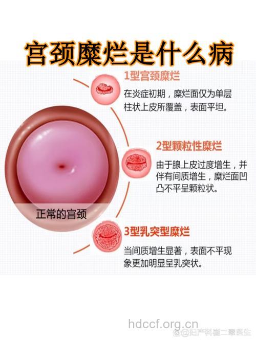 怎么辨别诊断真假宫颈糜烂