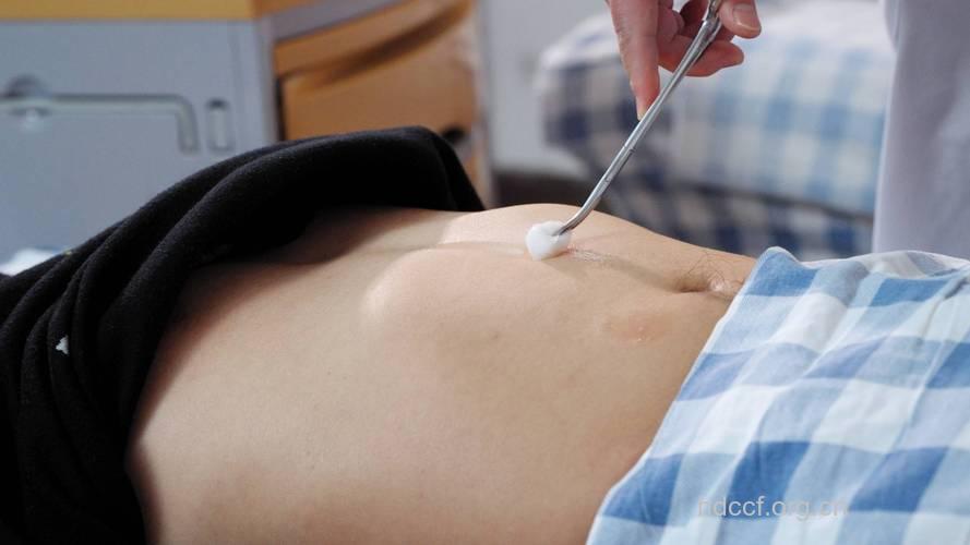 子宫脱垂的针灸疗法