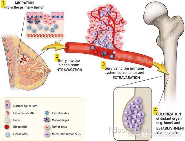 乳腺癌伴随的六大转移