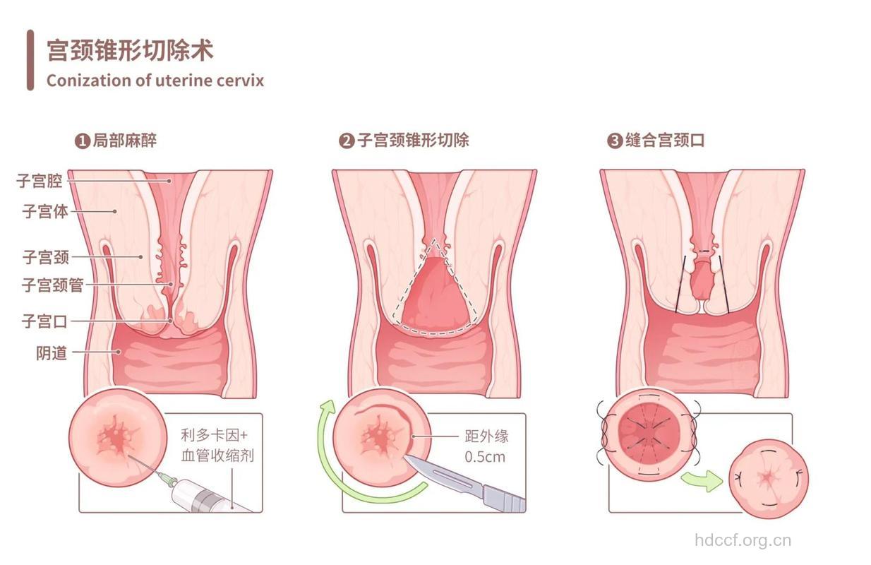 附件炎女性如何做人流手术