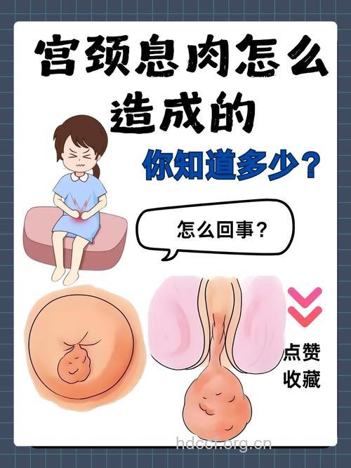 什么是宫颈息肉 宫颈息肉有什么危害