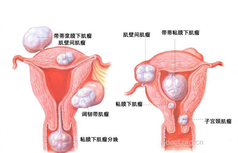 子宫内膜癌的出血特点 主要为阴道不规则出血