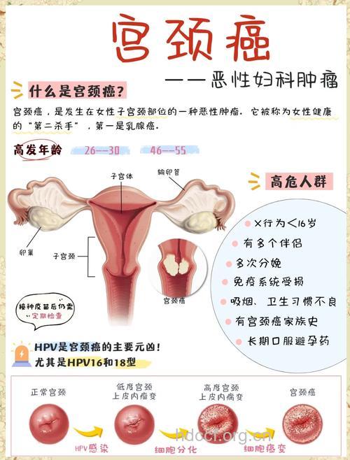 宫颈癌主要的病因是什么