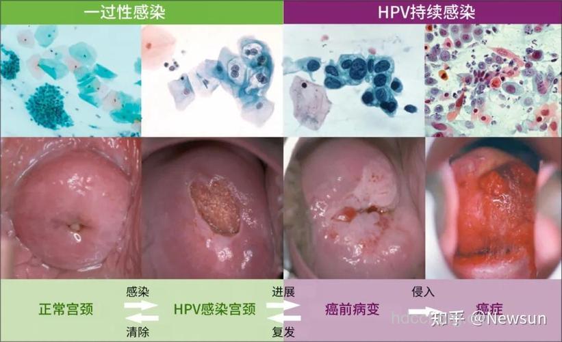 宫颈癌的初期症状是什么