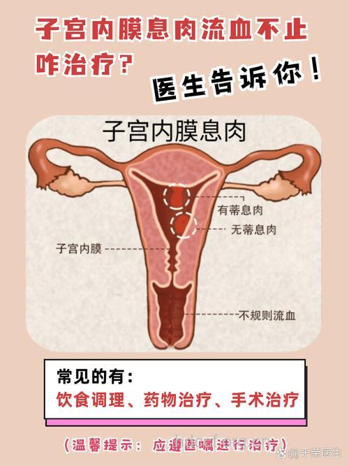 子宫内膜息肉可致不孕