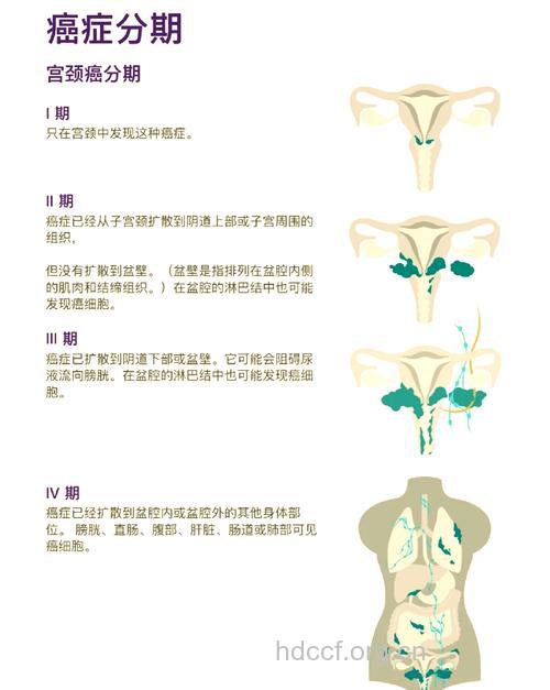 宫颈癌怎么进行分型呢