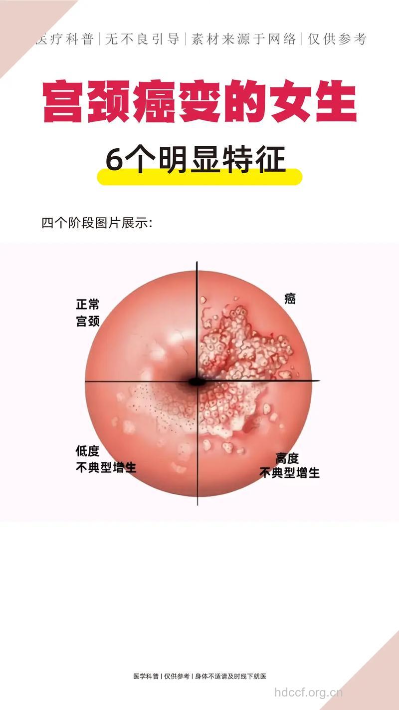 宫颈癌晚期有哪些症状呢