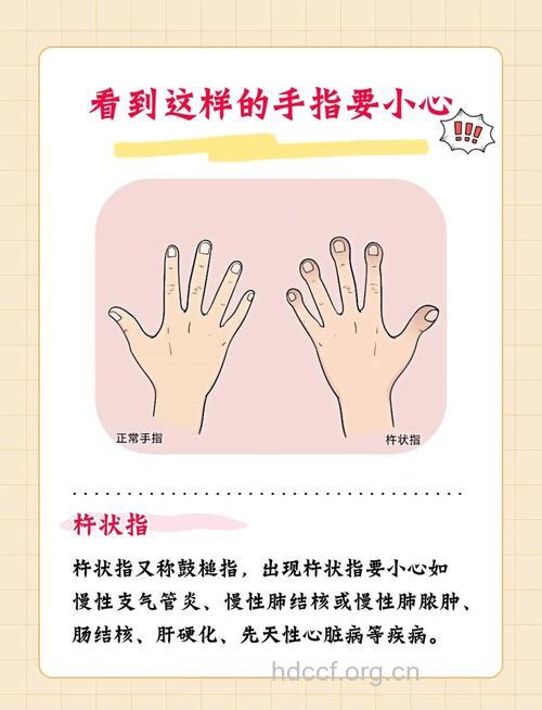 五指的秘密 从手指发现你的健康问题