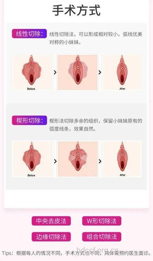 女性阴部为什么会变黑 11招保养女性阴部