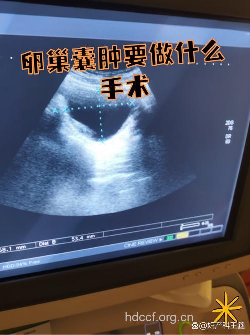 卵巢囊肿可以不开刀吗 较大的囊肿需手术