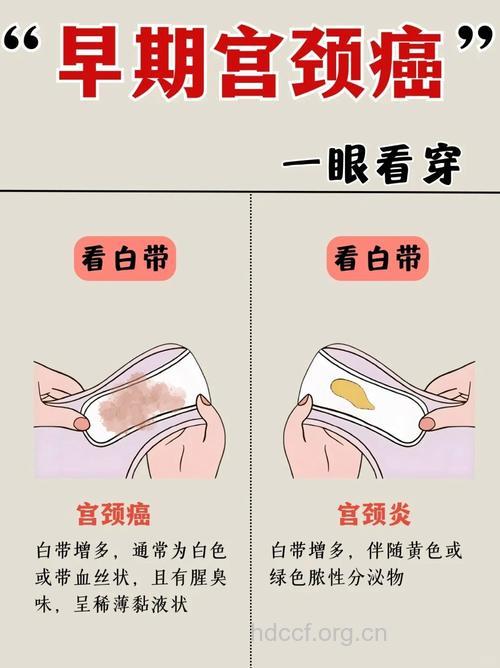 宫颈癌有哪些表现症状