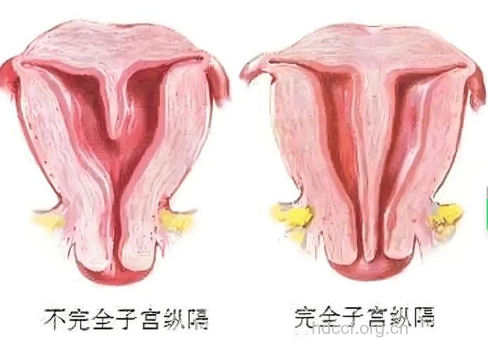 子宫纵隔是什么？是先天发育腔化不全的表现