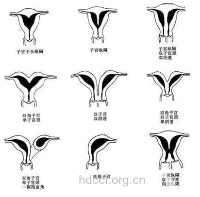 子宫畸形有哪些类型
