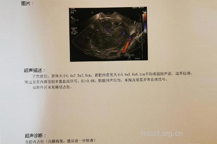 怀疑有子宫内膜癌应做诊断性刮宫