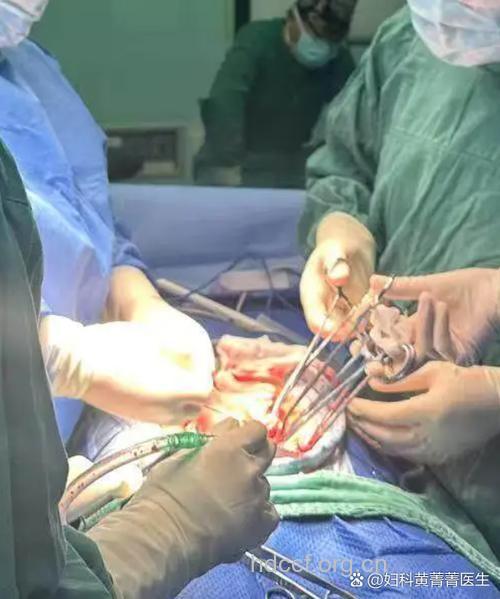 子宫畸形可手术治疗