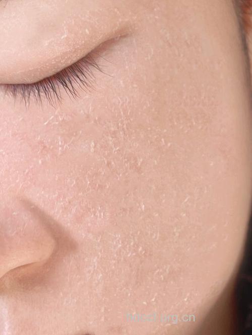 皮肤缺水容易出现问题肌肤！