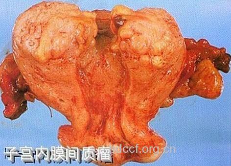 子宫肉瘤 子宫肉瘤有哪些症状
