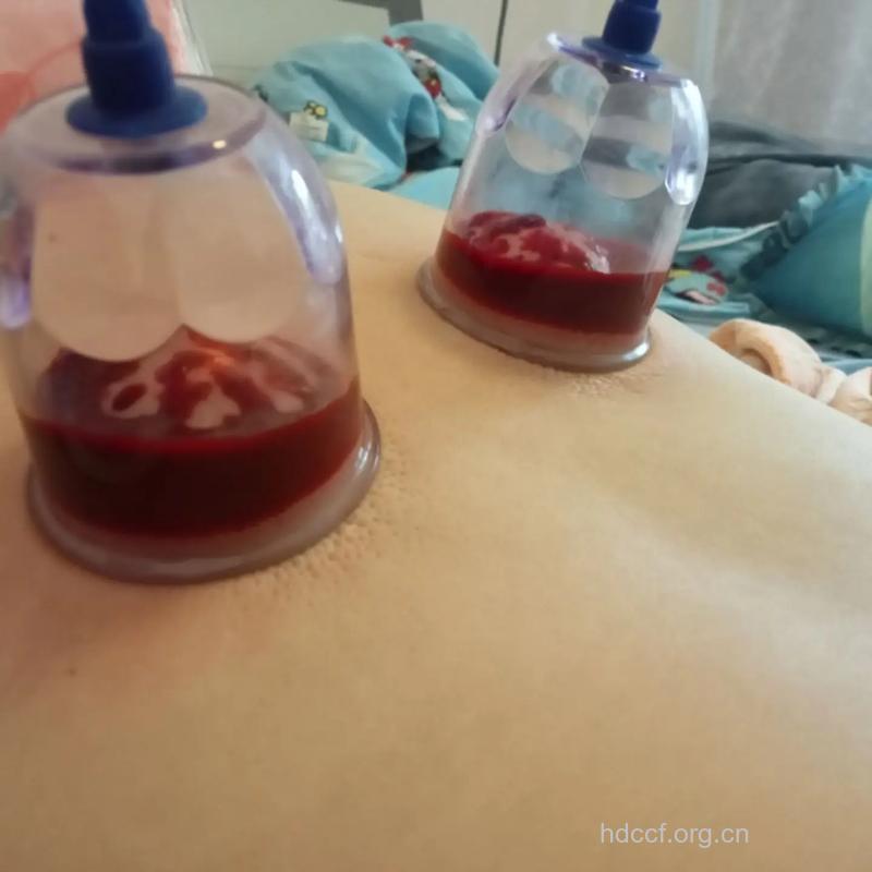 女性祛除淤血就该这么做