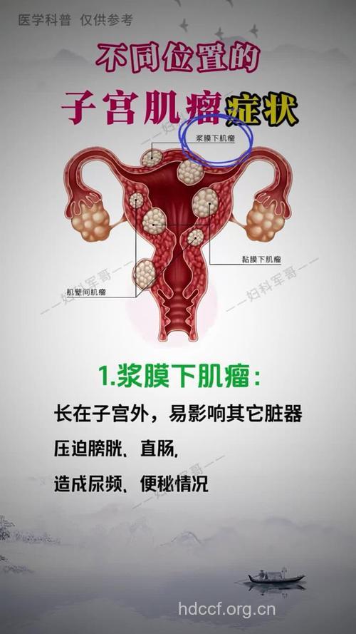 子宫肉瘤的症状和体征