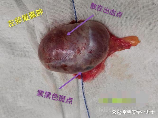 卵巢囊肿的蛛丝马迹