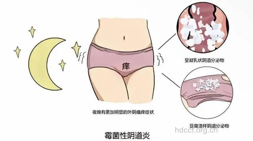 女人私处瘙痒的真正凶手是什么