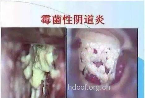 女性冬季吃火锅 当心吃出霉菌性阴道炎