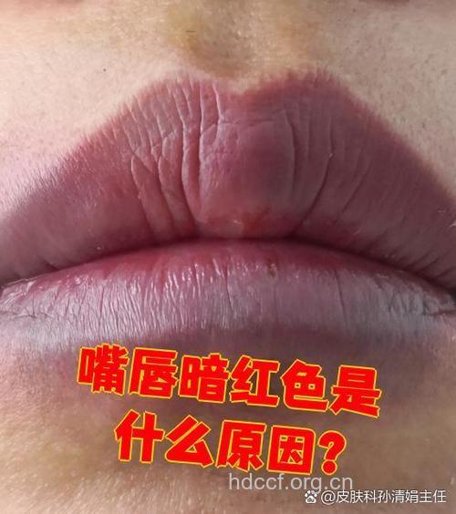 嘴唇深红色或紫红色是怎么回事