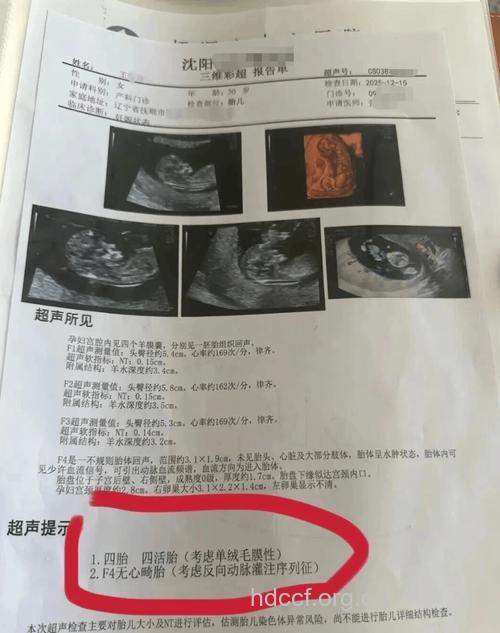 第一次B超怎么做 4种情况孕妇要当心