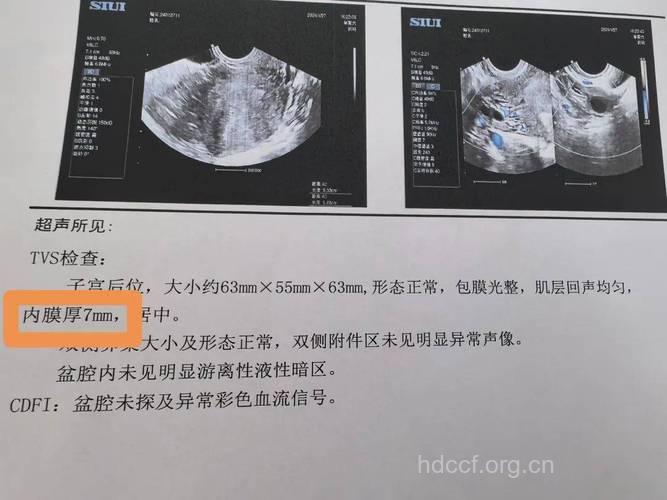什么是子宫附件b超检查 具体检查什么