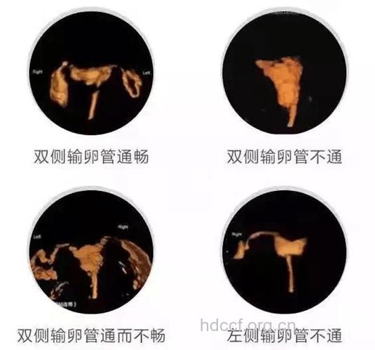 输卵管造影检查全过程 你需要了解