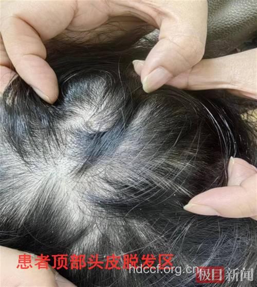 与宠物共眠头癣会导致脱发