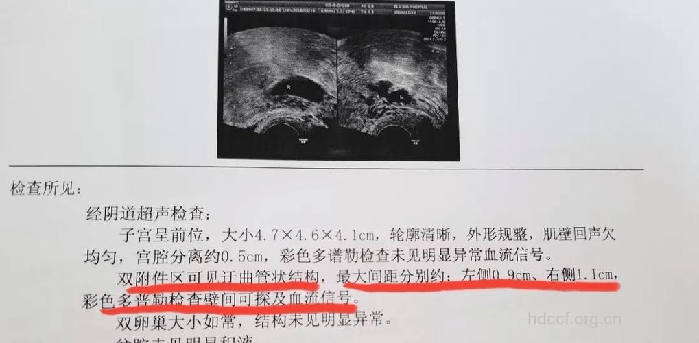 妇科B超有哪些分类