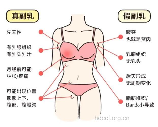 副乳形成的原因