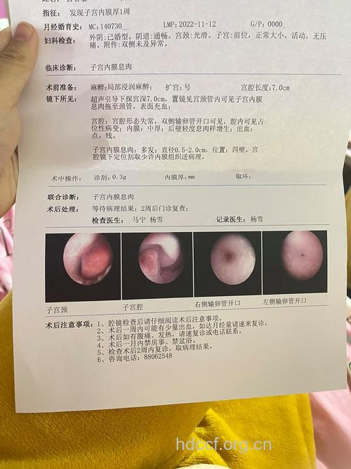 子宫内膜息肉要做的4类检查