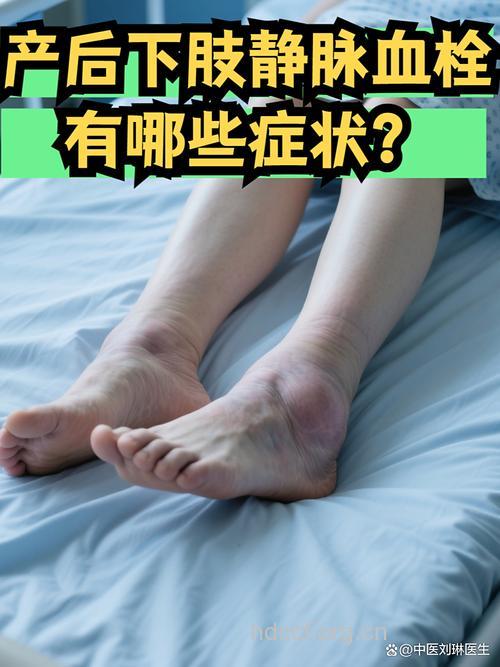 产后要小心静脉血栓