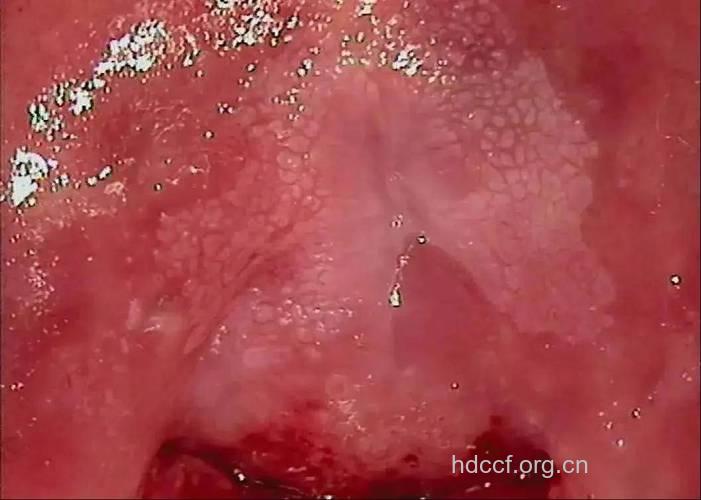 阴道镜图像的专家解释
