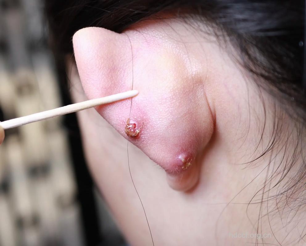 少女乱扎耳洞有什么危害
