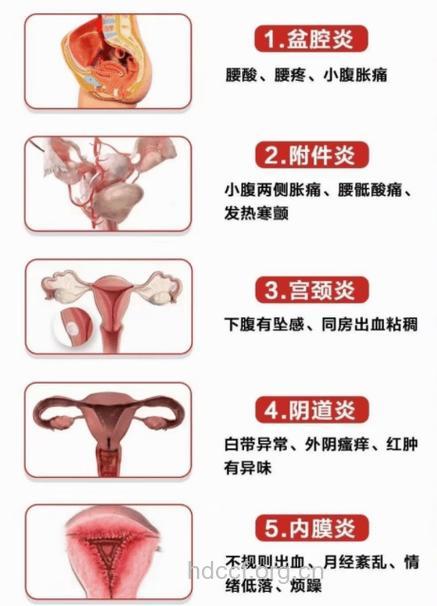 夏季女人如何预阴道炎