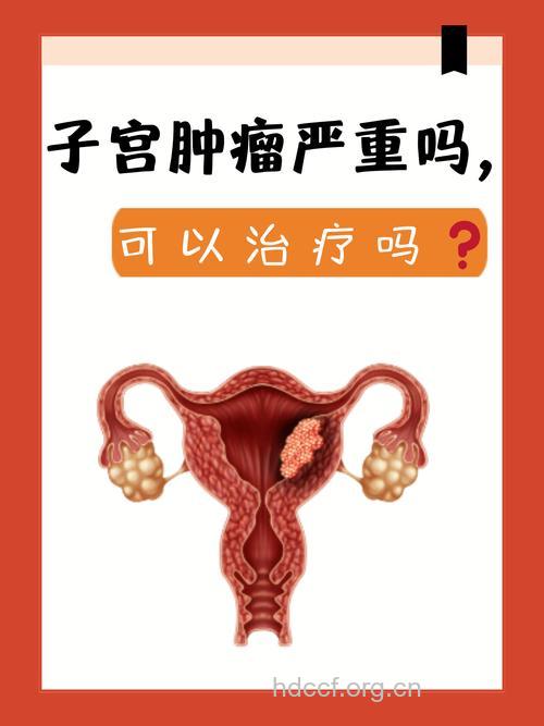 “丁克女性”妇科肿瘤多