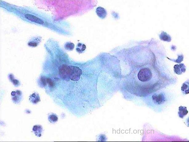 详解宫颈涂片的巴氏分级法