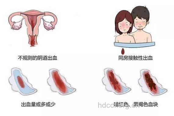 阴道出血的9种类型