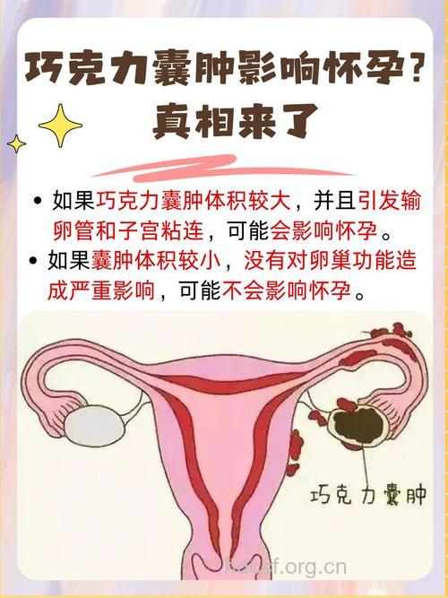 你知道什么事巧克力囊肿