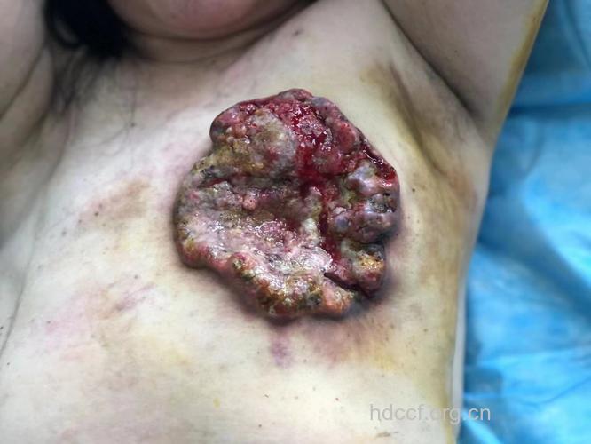 乳腺癌的临床表现