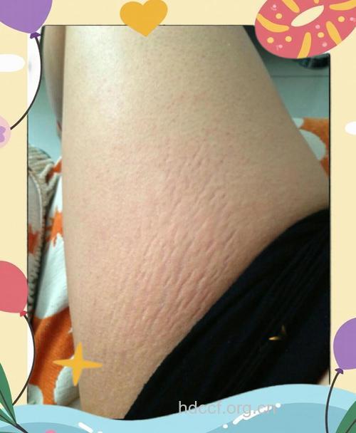 孕妇防晒不长妊娠斑纹