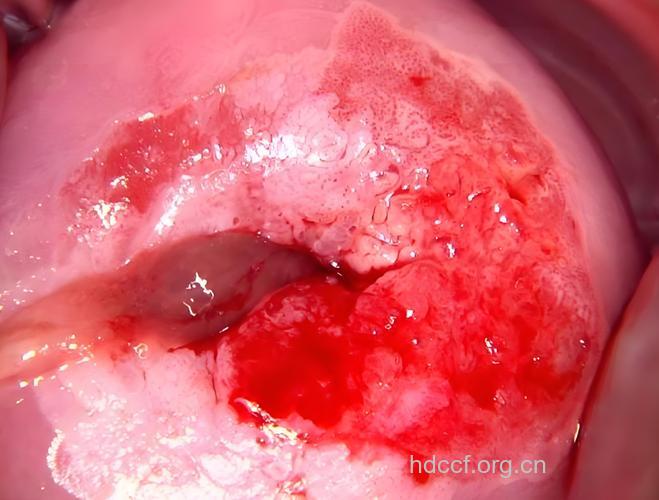 下体异常出血竟是宫颈癌