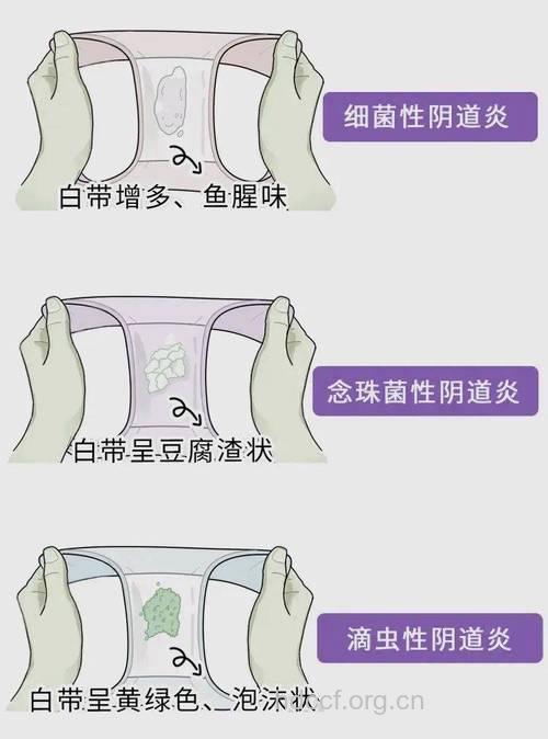 女人不穿内裤会导致阴道炎